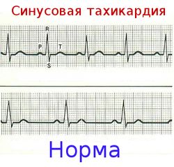 Схема анализа синусовой тахикардии к норме